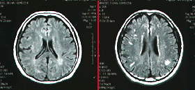 脳の断層写真